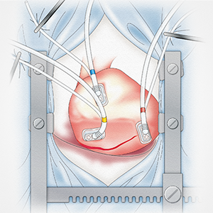 The Tentacles positioner's novel three-cup vacuum system was designed to secure heart positioning and reduce the risk of trauma.