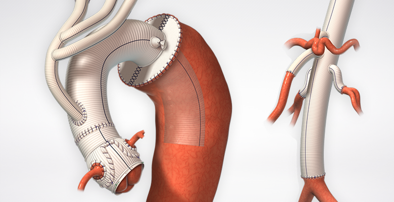 Aortic And Vascular Graft Devices Pipeline Product Market Terumo Aortic Vascular Grafts : Products : Terumo Cardiovascular Systems