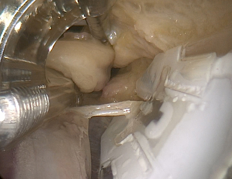 EVH Training Session 3: Endoscopic Radial Artery Harvesting: When,why and how?